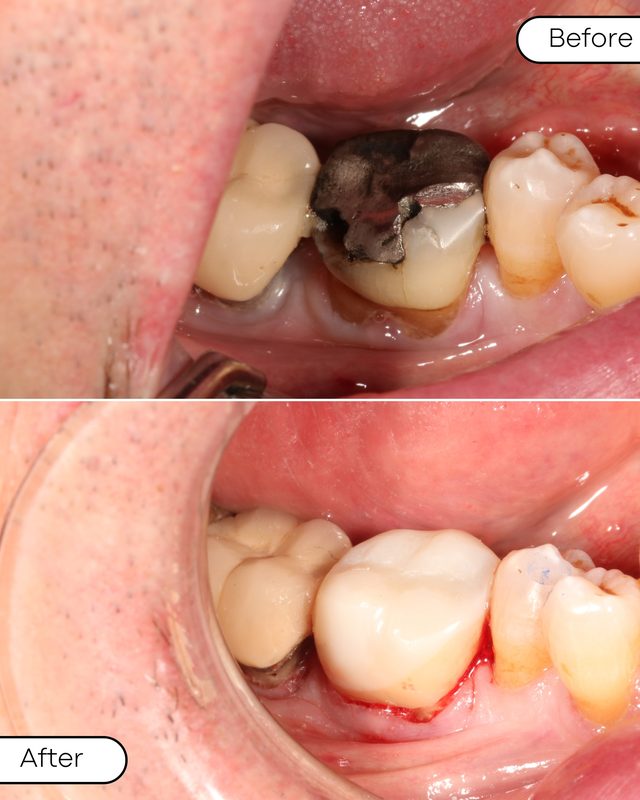 Before and after safe amalgam removal