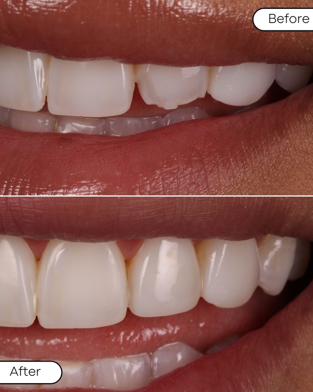 Before and after chipped tooth repair
