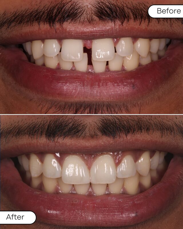 Before and after gap closure