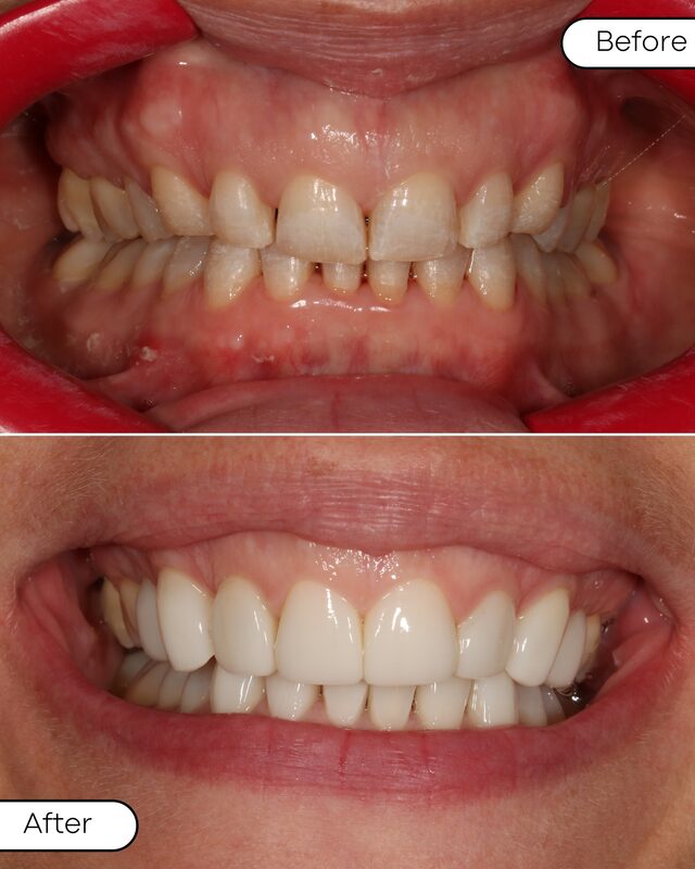 Before and after smile makeover